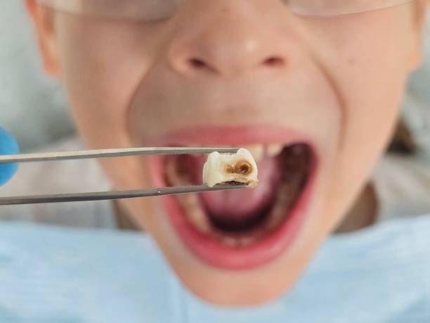 Best Broken or Chipped Tooth Repair in Calumet City, IL