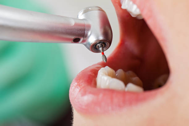 Best Emergency Wisdom Tooth Extraction in Calumet City, IL